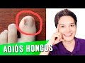 COMO ELIMINAR LOS HONGOS DE LAS UÑAS DE LOS PIES Y MANOS CON REMEDIOS CASEROS | ONICOMICOSIS