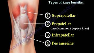 Knee Bursitis,prepatellar bursitis  - Everything You Need To Know - Dr. Nabil Ebraheim