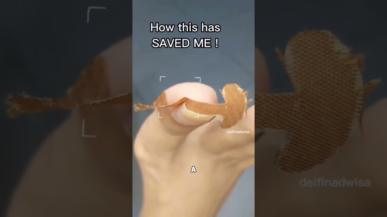 Эффективный корректор для вросших ногтей