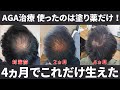 【薄毛で悩む人必見】25歳ハゲ AGA治療を始めて4ヵ月 想像以上に生えました！