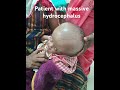 Hydrocephalus in Babies: What Every Parent Needs to Know #hydrocephalus #babyhealth #parenting
