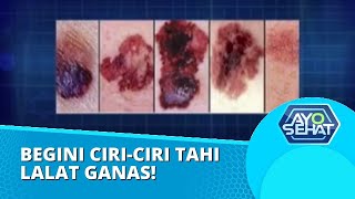 Bagaimana Cara Membedakan Tahi Lalat Jinak dengan Tahi Lalat Ganas? Simak Disini! | AYO SEHAT