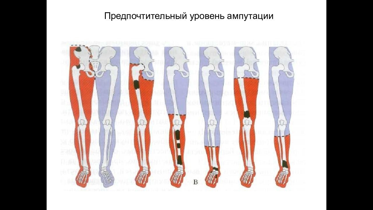 Ампутация конечности