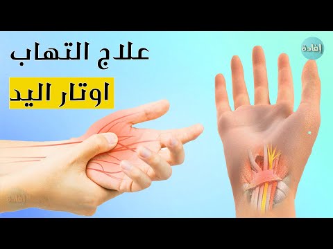 علاج التهاب اوتار اليد