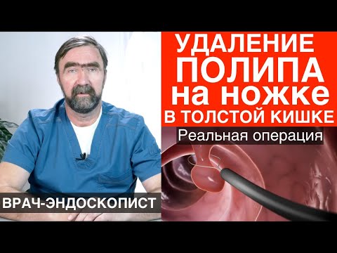 УДАЛЕНИЕ ПОЛИПА на НОЖКЕ в ТОЛСТОЙ КИШКЕ (в кишечнике). Классическая полипэктомия при колоноскопии.