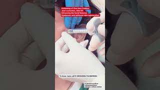 Achieving A V Line Face, Jawline Contour