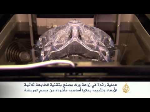 زراعة ورك معدني مصنع بتقنية الطباعة ثلاثية الأبعاد