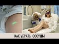 КАК УДАЛИТЬ СОСУДИСТЫЕ ЗВЁЗДОЧКИ?