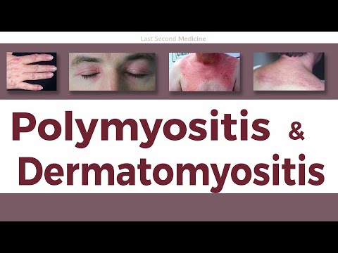 પોલિમાયોસાઇટિસ અને ડર્માટોમાયોસાઇટિસ - ક્લિનિકલ લક્ષણો, ઇન્ફ્લેમેટરી માયોસાઇટિસનું નિદાન અને સારવાર