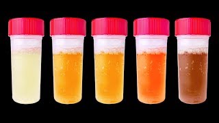 尿からわかる７つの健康状態