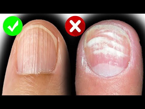 How to treat nail ridges the natural way – sundays