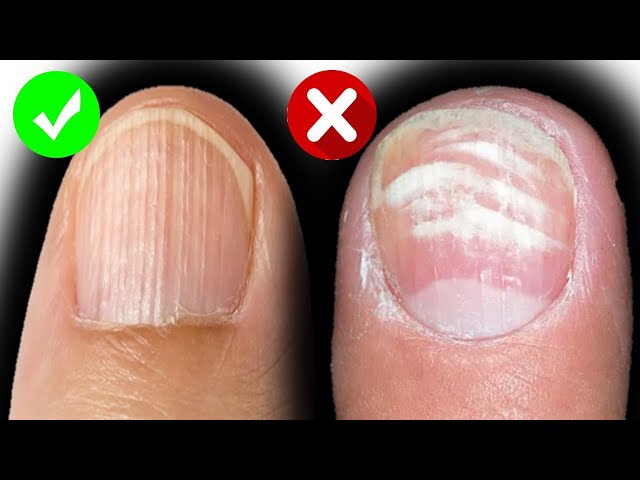 What Do You Do if Your Client Has Beau's Lines? | Nailpro