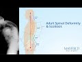 Adult Spinal Deformity and Scoliosis