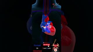 When The Heart Goes Wrong! Sinus Vs Afib Heartbeats 3D Animation.