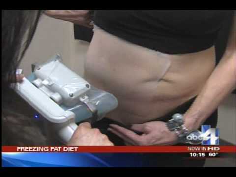 Zeltiq Utah - Freeze Fat - Dr. Robert L. Orme, Dra...