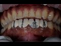 How to remove old dental crowns without breaking teeth