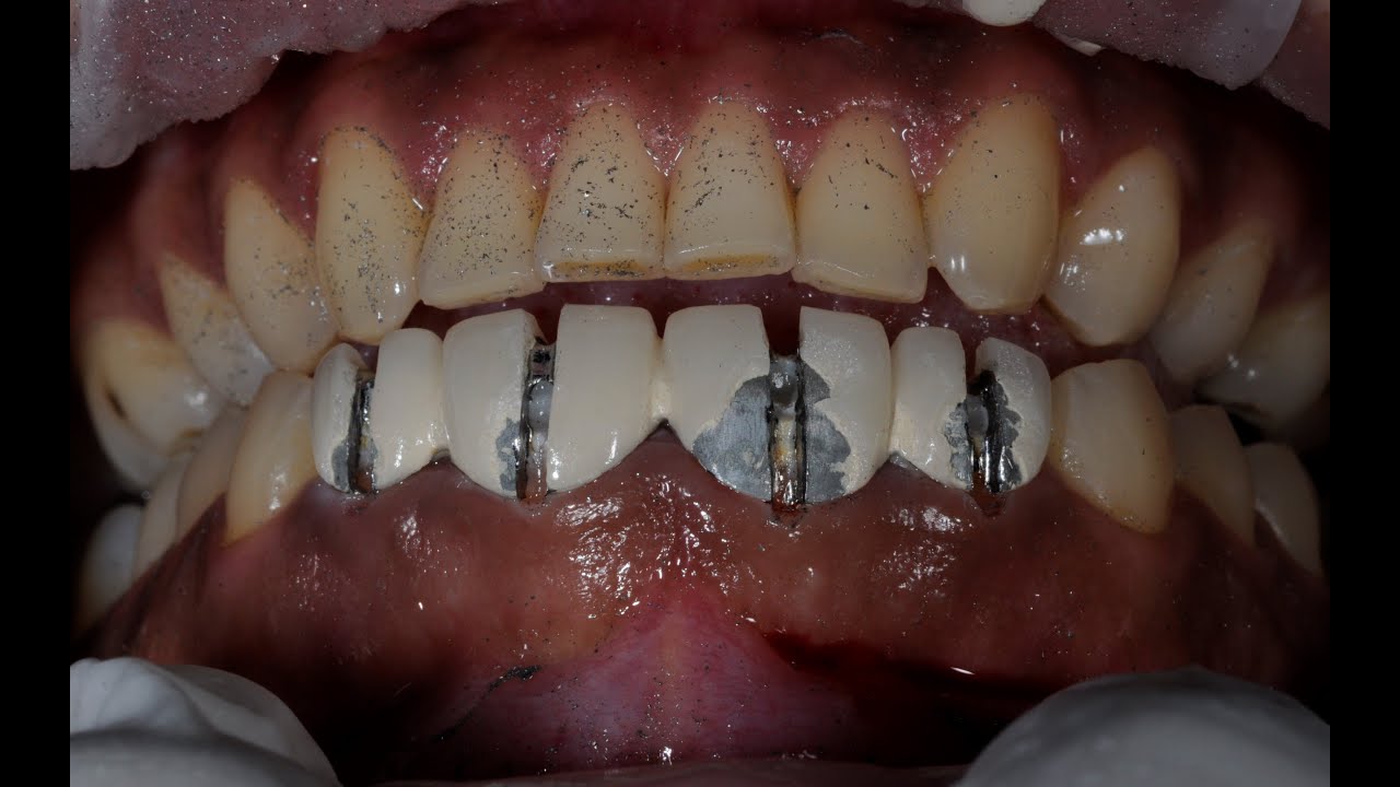 How Does A Dentist Remove A Crown To Replace It