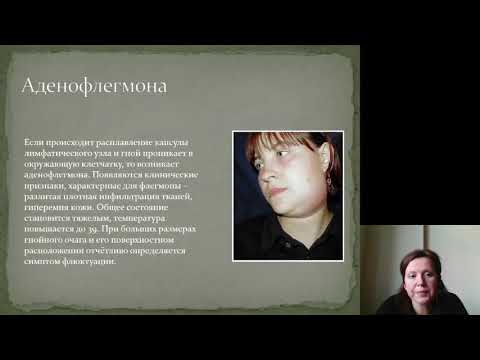 Хирургия полости рта 1. Лимфадениты лица и шеи