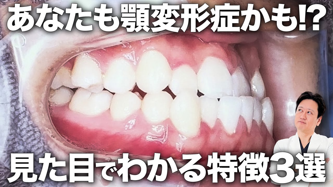 自宅でセルフチェック！顎変形症の特徴と治療法を教えます！【審美歯科 歯並び 歯列矯正 受け口】