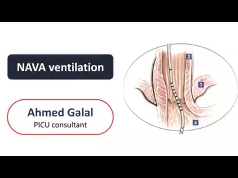 enchufe Chorrito Consulta NAVA ventilation Neurally Adjusted Ventilatory Assist Dr Ahmed Galal -  YouTube