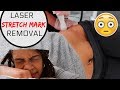 Laser Stretch Mark Removal  INFO + MY PROCEDURE