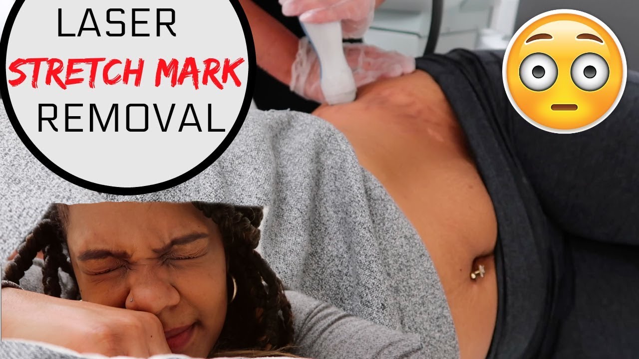 Laser Stretch Mark Removal with Icon™: AccessMedicine: Direct Primary Care