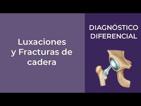 Vídeo: Luxación De Cadera: Síntomas, Diagnóstico Y Tratamiento De La Luxación De Cadera. Prevención
