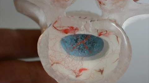 Disc Herniation Models (Group A) - Bulging, protrusion, and extrusion