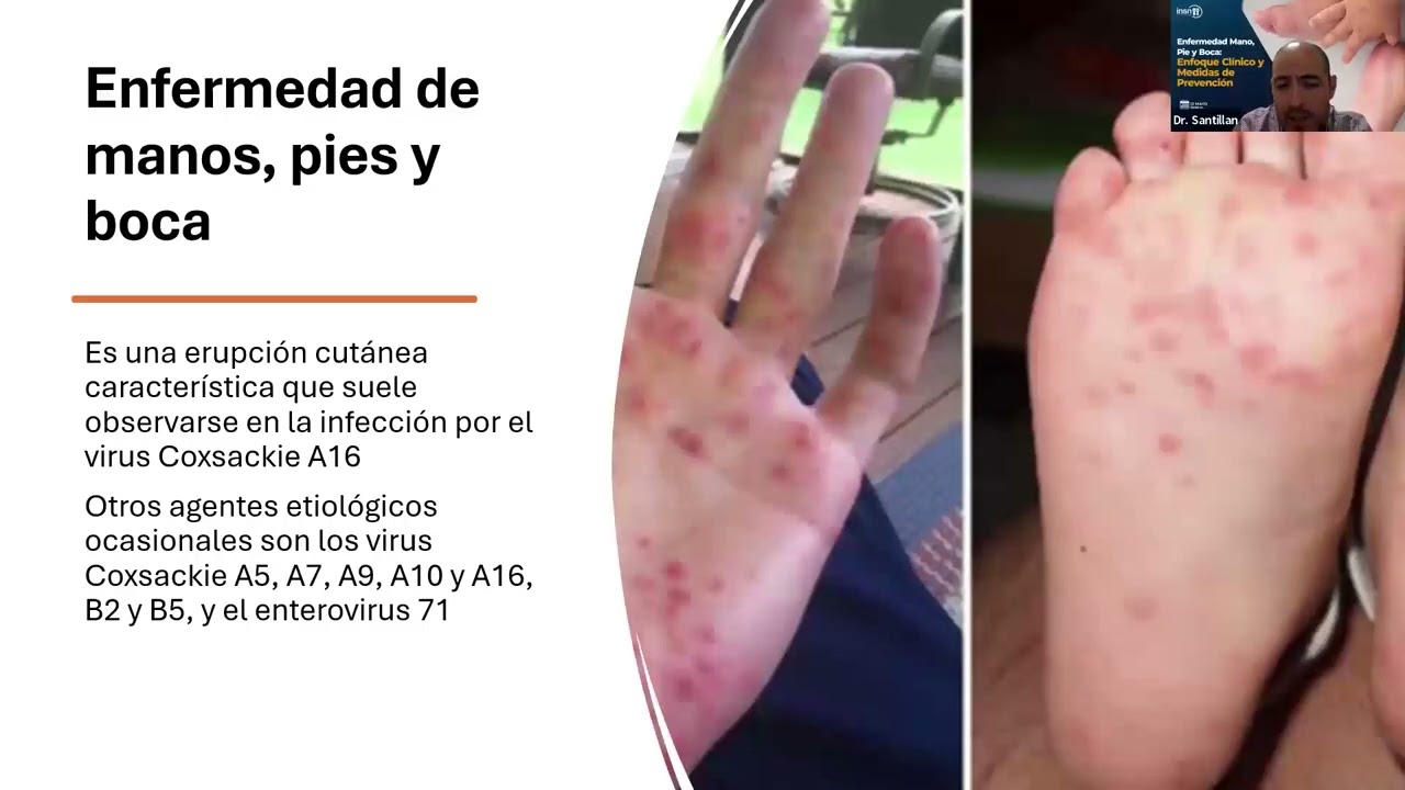 TeleIEC - Enfermedad Mano, Pie y Boca: Enfoque Clínico y Medidas de Prevención
