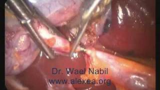 Unexpected Surprise Laparoscopic Cholecystectomy.wmv