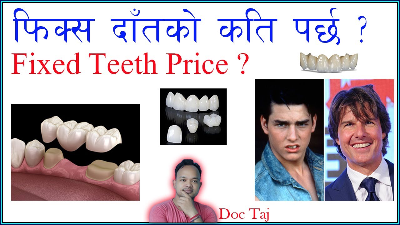 Fixed Partial Denture Price/FPD/ फिक्स दाँतको दाम/ Dental Bridge/ Doc Taj / Dentist in Kathmandu