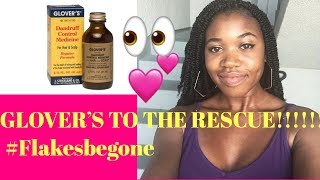 REALISTIC HOW TO GET RID OF DANDRUFF! | GLOW UP SERIES | GLOVER’S DANDRUFF CONTROL MEDICINE screenshot 5