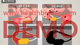 [시연용]c0063aako_[대한산부인과학회] 난임의 원인별 치료방법 안내 (난임)