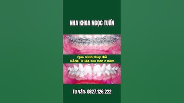 QUÁ TRÌNH THAY ĐỔI RĂNG THƯA SAU HƠN 2 NĂM GẮN MẮC CÀI #nhakhoauytintaithaibinh #reels #niengrang