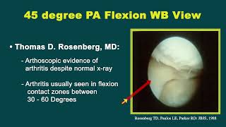 Managing Knee Arthritis