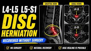 L4 L5  L5 S1 Disc Herniation