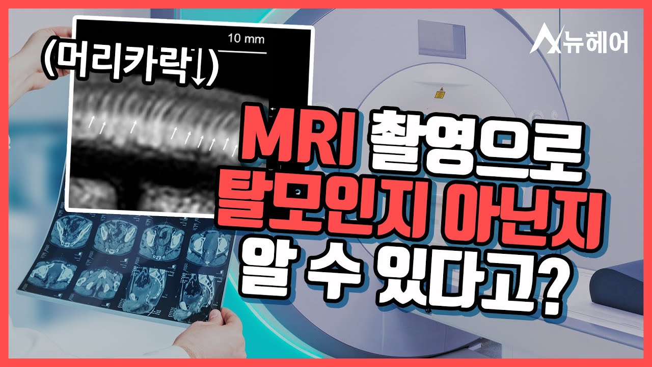MRI 촬영으로 탈모 진단을 할 수 있다?ㅣ탈모 검사ㅣ뉴헤어