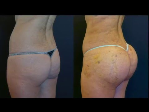 What makes you a good candidate for buttock augmentation using fat transfer?