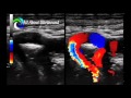 All About Ultrasound: Tortuous ICA Ultrasound