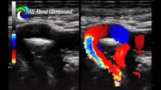 All About Ultrasound: Tortuous ICA Ultrasound