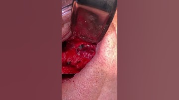 Maxillar Sinus Perforation Repair