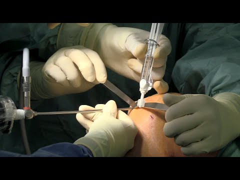 Minimal-invasive autologe Knorpelzelltransplantation mit Novocart Inject