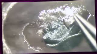 With Corrected With Gulani Technique To Vision