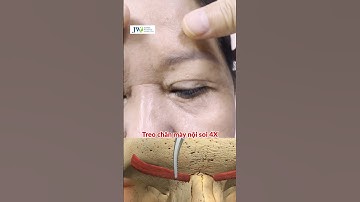 Bác sĩ Tú Dung TREO CHÂN MÀY NỘI SOI 4X hồi xuân HẾT NHĂN, xóa VẾT CHÂN CHIM trẻ 10 tuổi