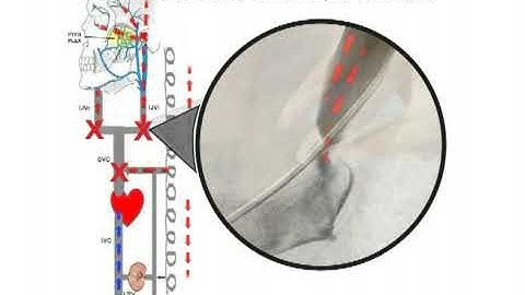 CCSVI and Multiple Sclerosis (ENGLISH AUDIO)