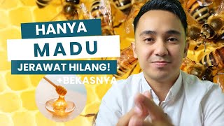 Cuma Modal Madu! Cara Alami Hilangkan Bekas Jerawat Menurut Penelitian