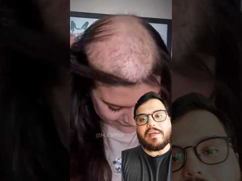 هوس نتف الشعر   معلومات طبيه جلدية تجميل شورت شورتس نصائح طبية رياكشن