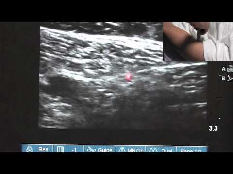 Ultrasound Guided Saphenous Nerve Block - www.neverfullbag.com - YouTube