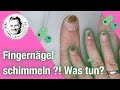 Fingernägel schimmeln - Greenie, Stockflecken und Nagelpilz - Was tun?