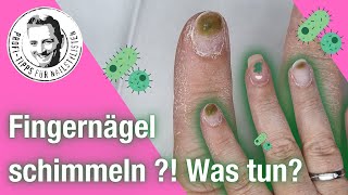 Fingernägel schimmeln - Greenie, Stockflecken und Nagelpilz - Was tun?